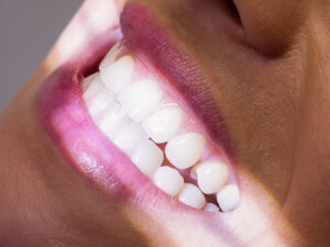 clareamento dental