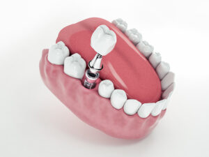 Implantes dentários