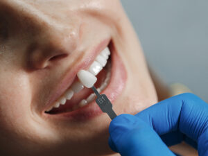 lentes de contato dental