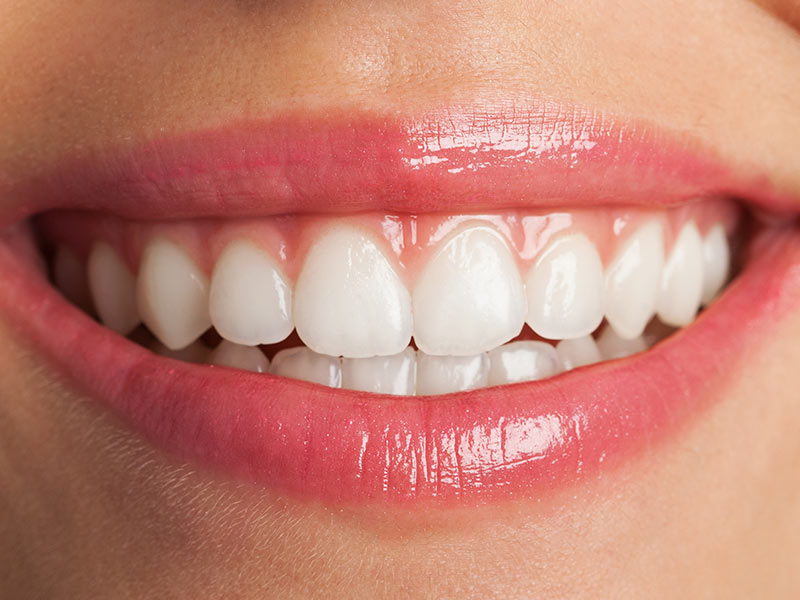 gengivoplastia